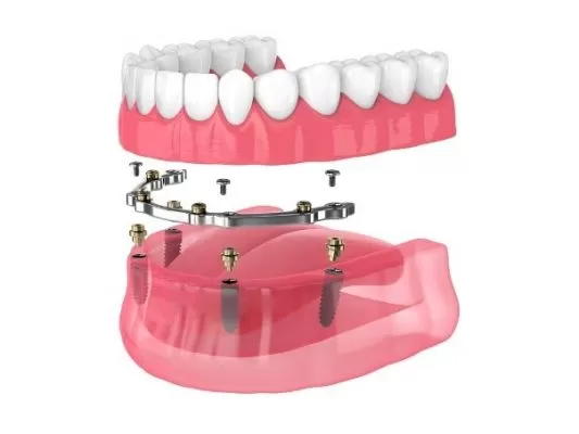 Implant framework retained fixed dentures